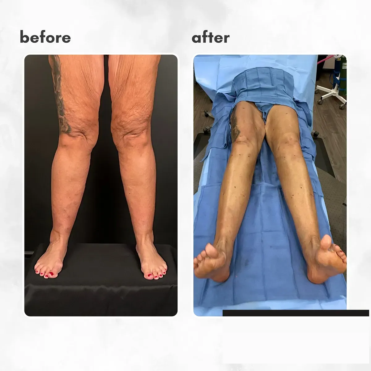 Lipedema before-and-after comparison.