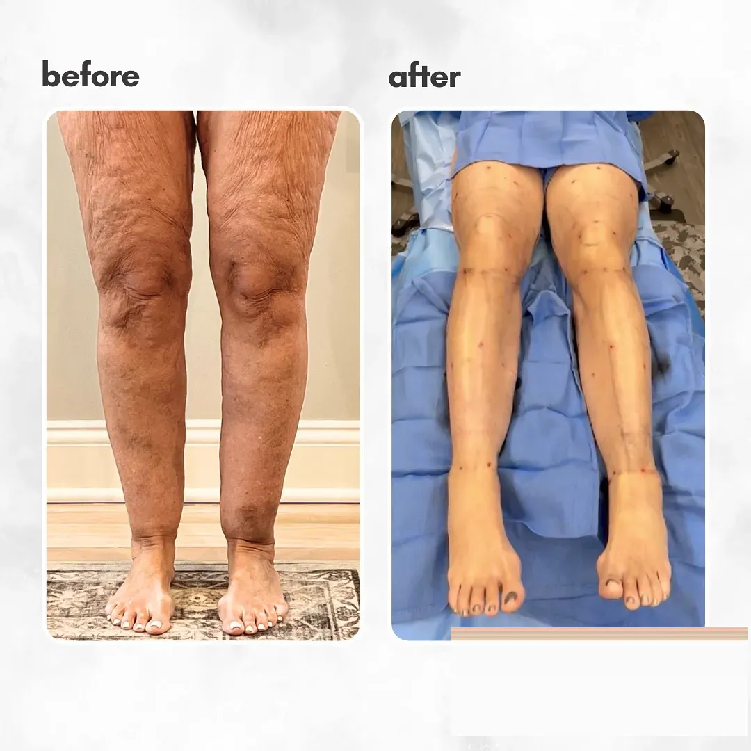 Lipedema before-and-after comparison.