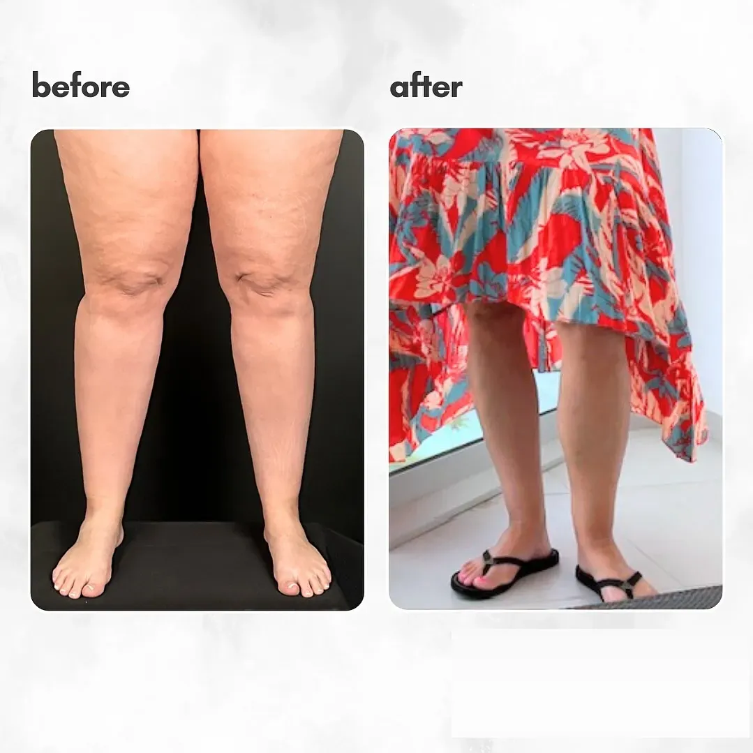 Lipedema before-and-after comparison.