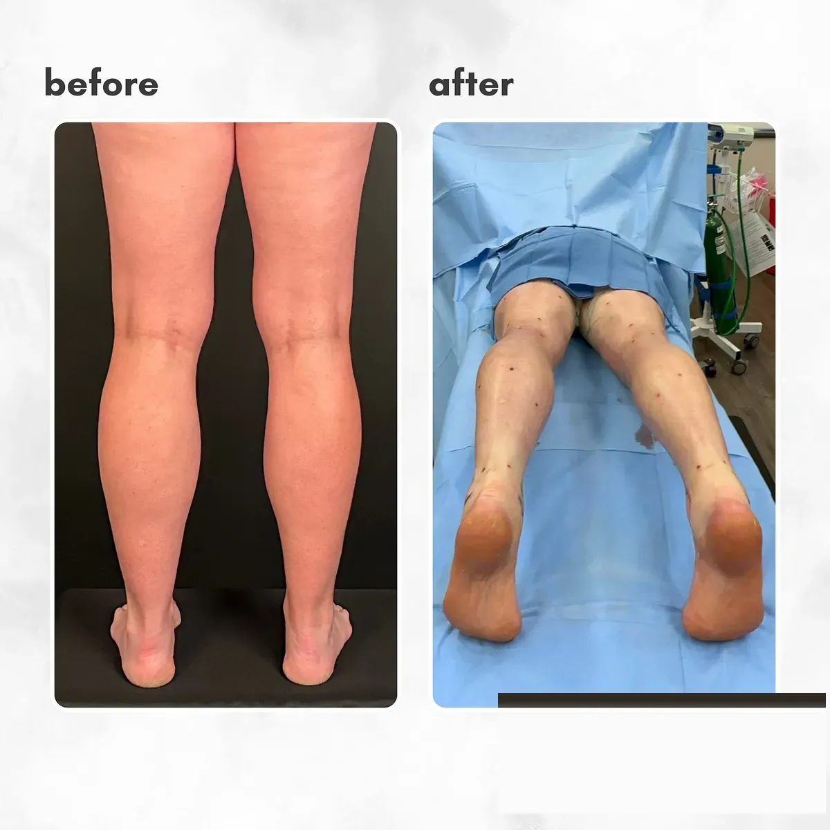 Lipedema before-and-after comparison.