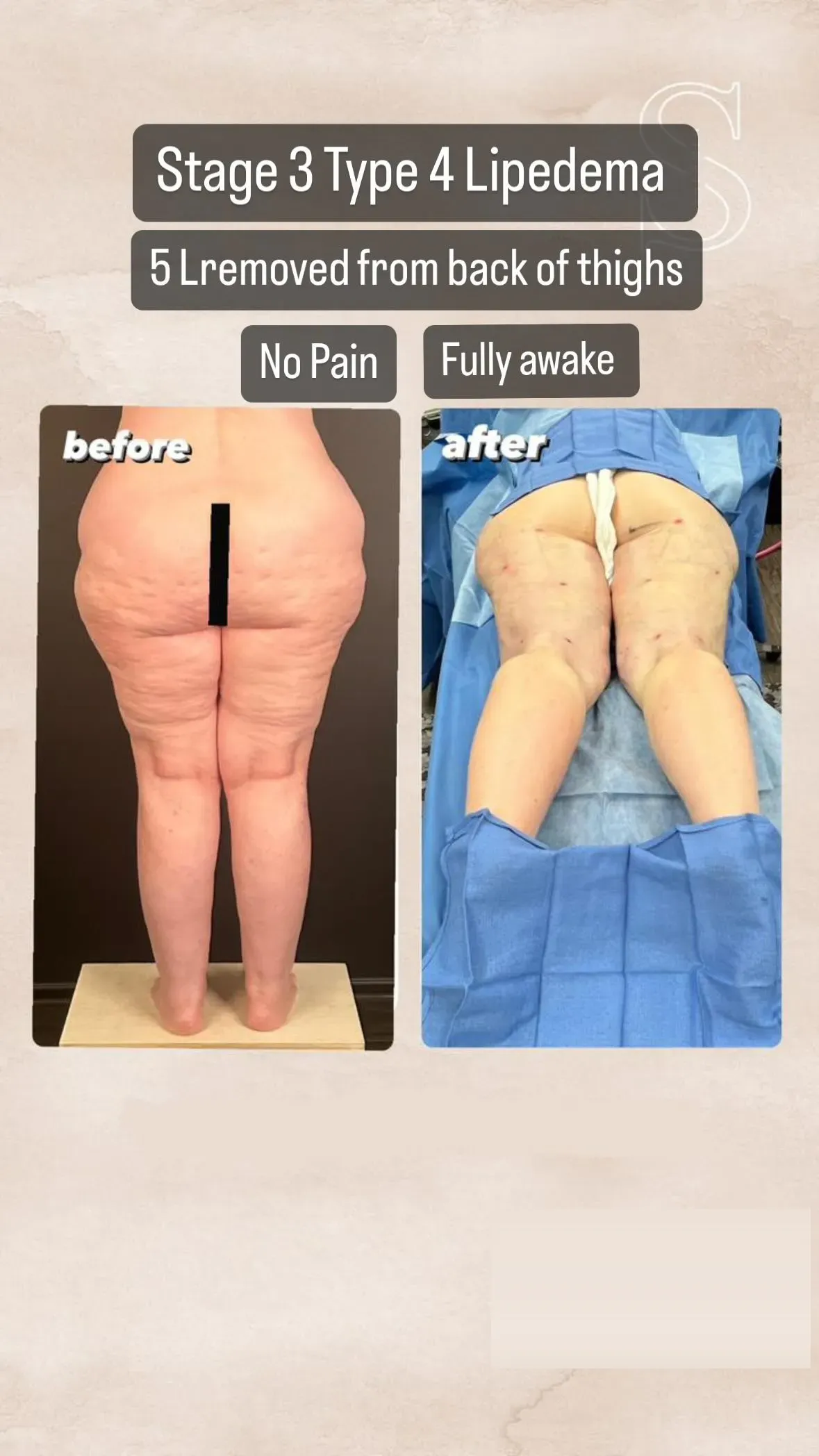 Lipedema before-and-after comparison.