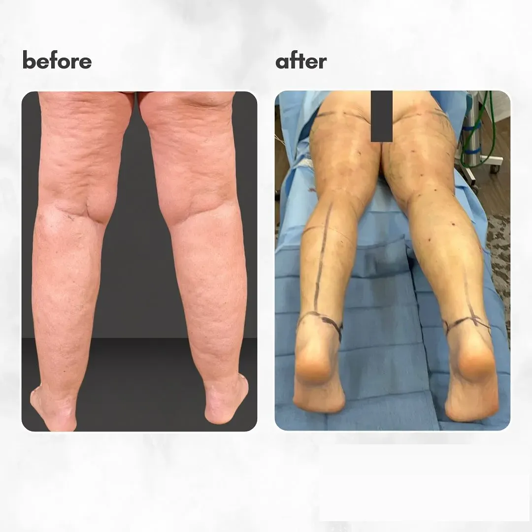 Lipedema before-and-after comparison.