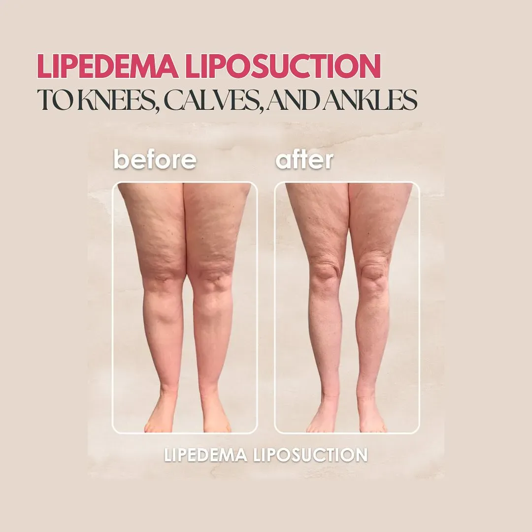 Lipedema before-and-after comparison.