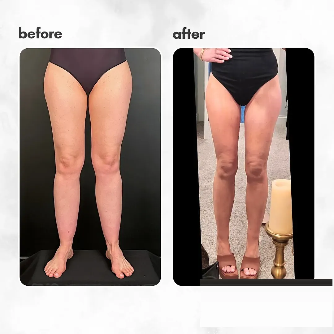 Lipedema before-and-after comparison.
