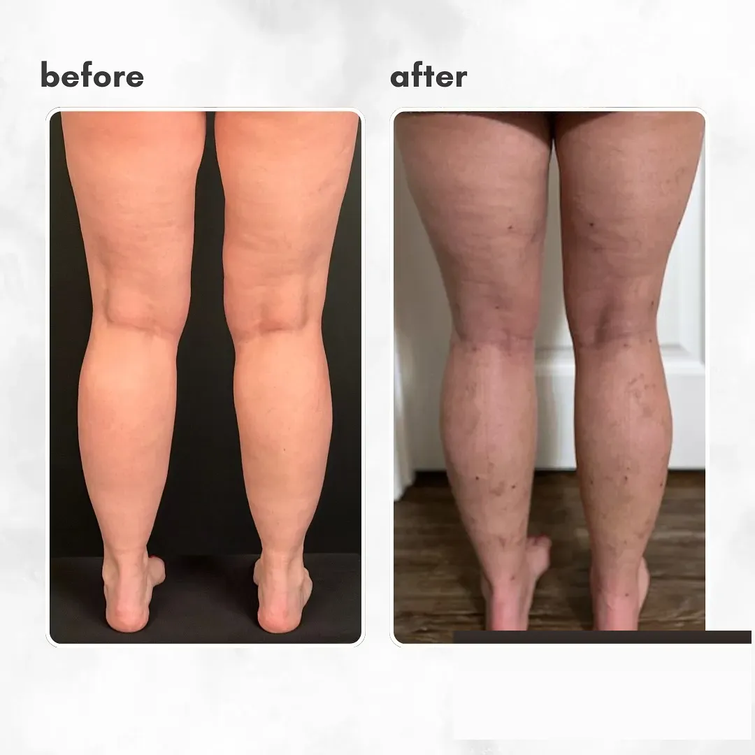 Lipedema before-and-after comparison.