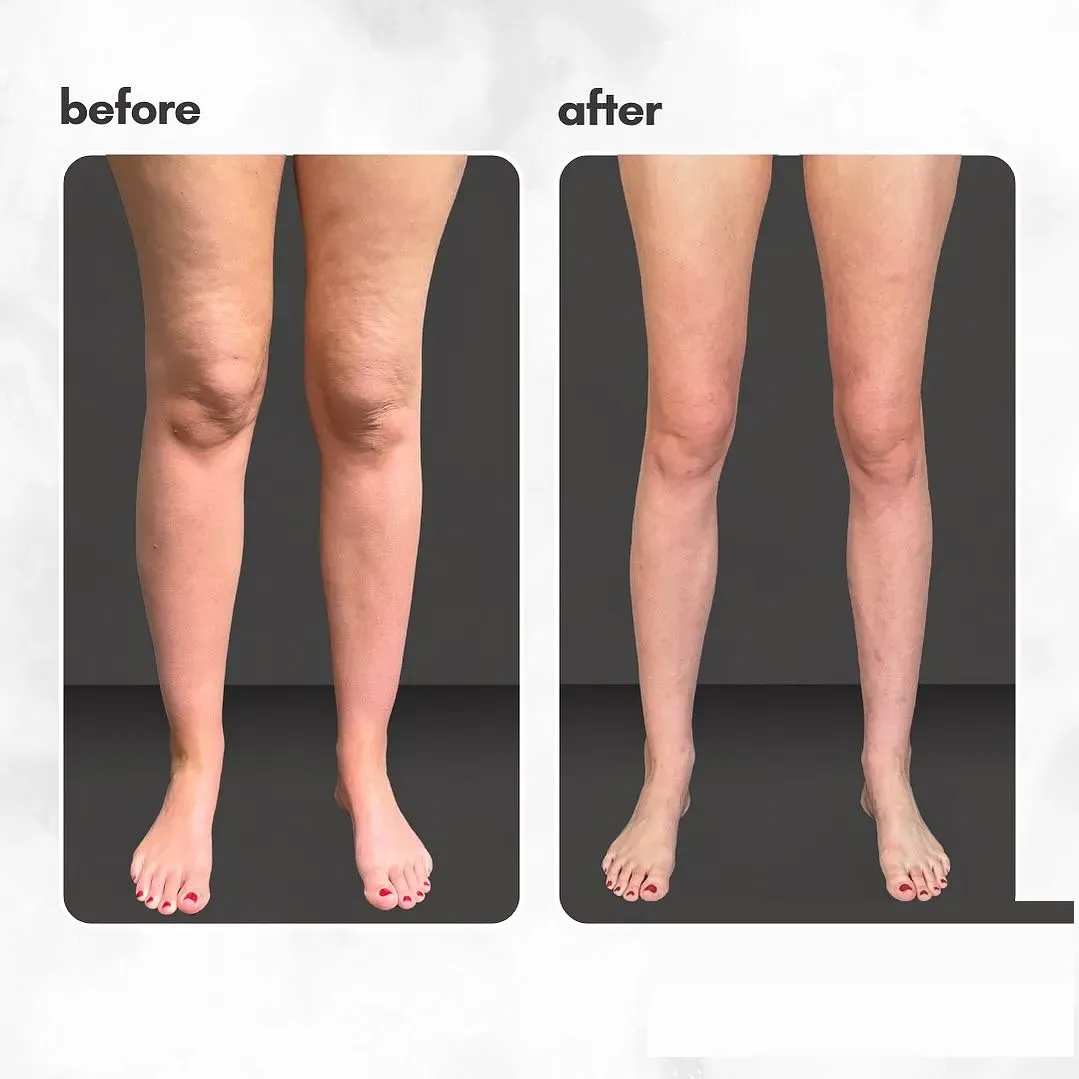 Lipedema before-and-after comparison.