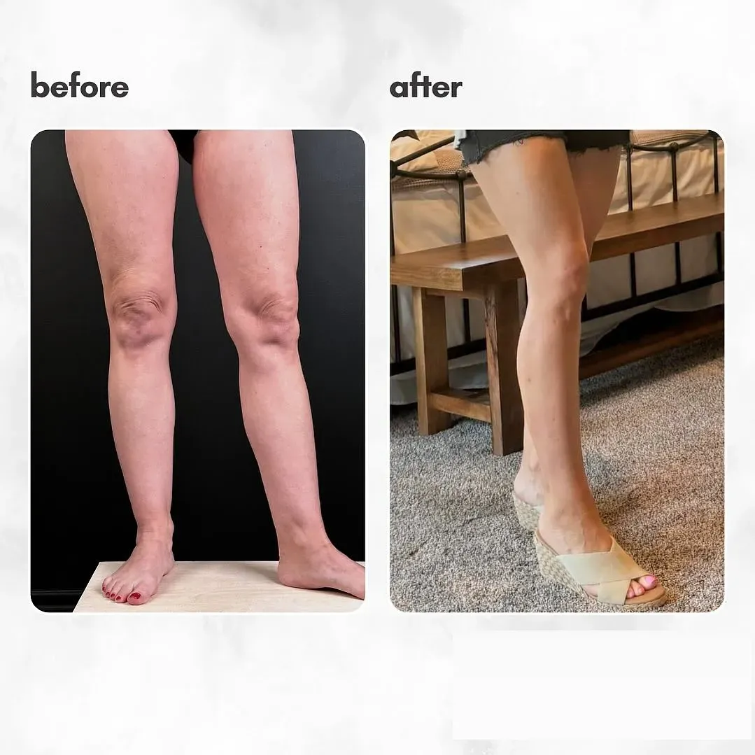 Lipedema before-and-after comparison.