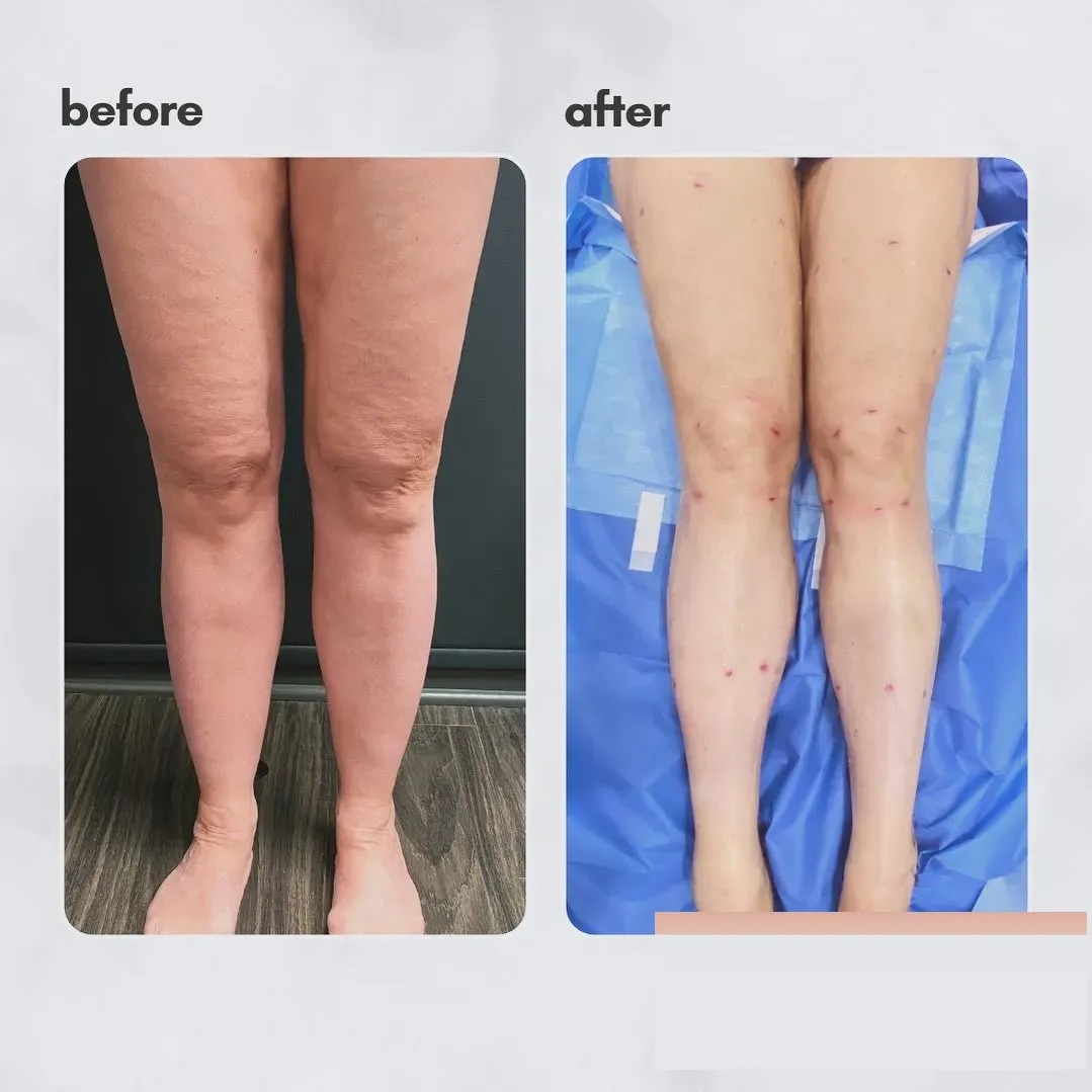 Lipedema before-and-after comparison.