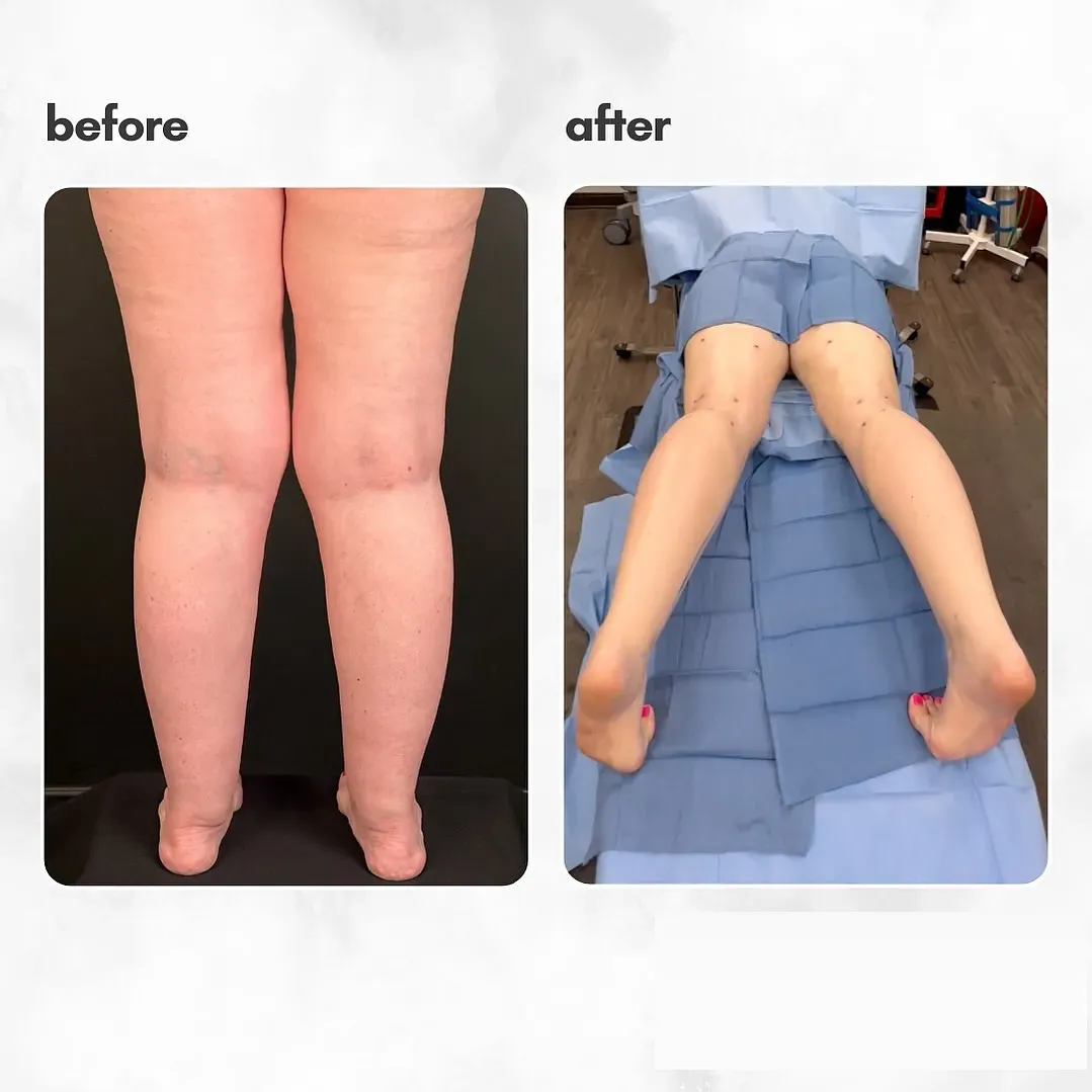Lipedema before-and-after comparison.