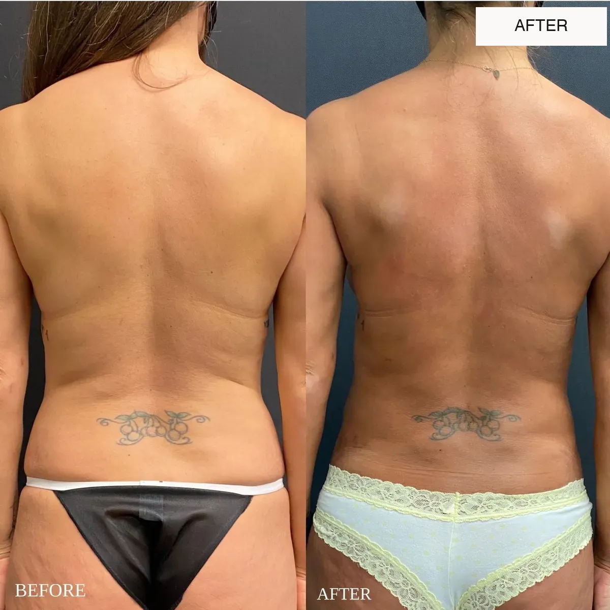 Back and waist before-and-after comparison.
