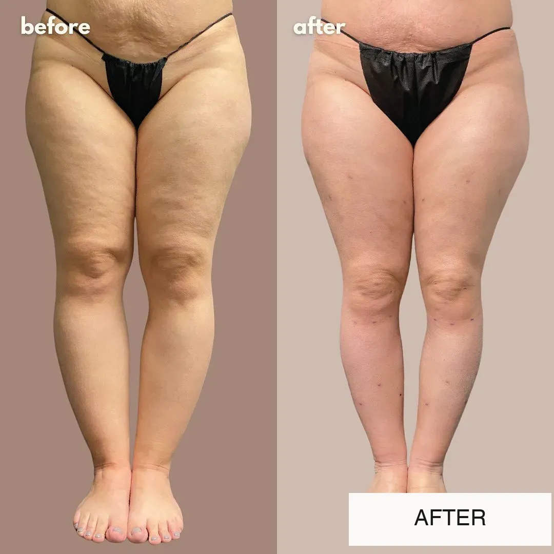 Lipedema before-and-after comparison.