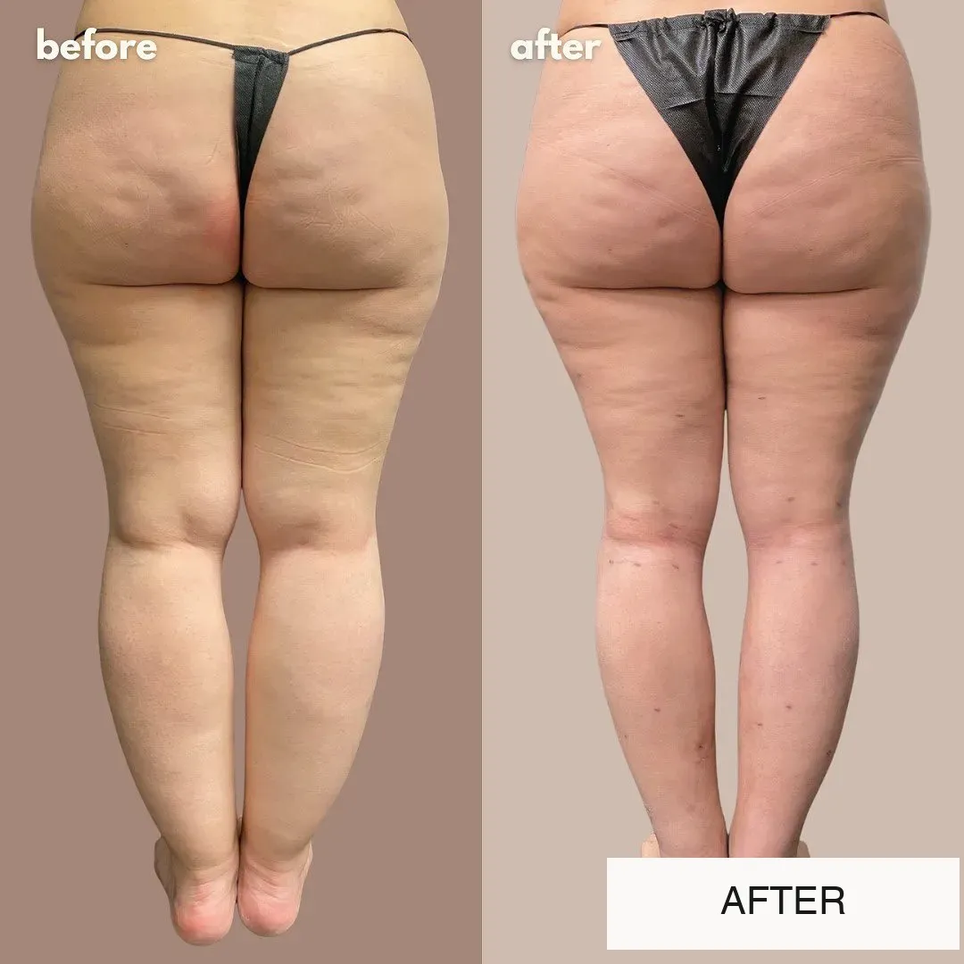 Lipedema before-and-after comparison.
