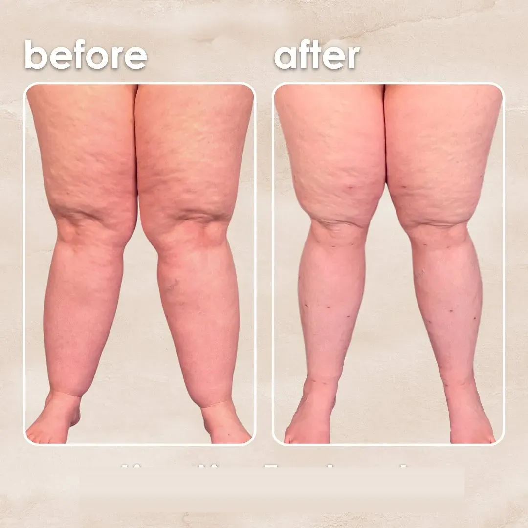 Lipedema before-and-after comparison.