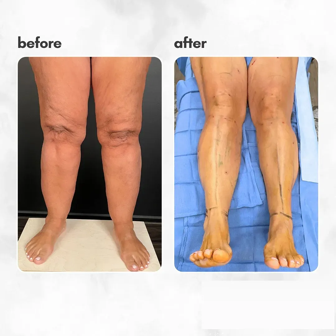 Lipedema before-and-after comparison.