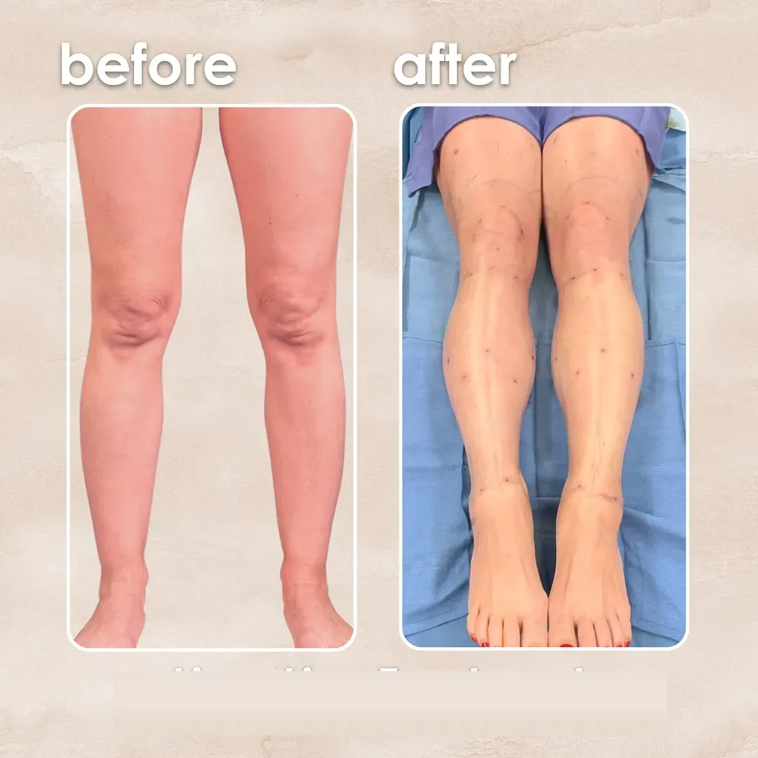Lipedema before-and-after comparison.