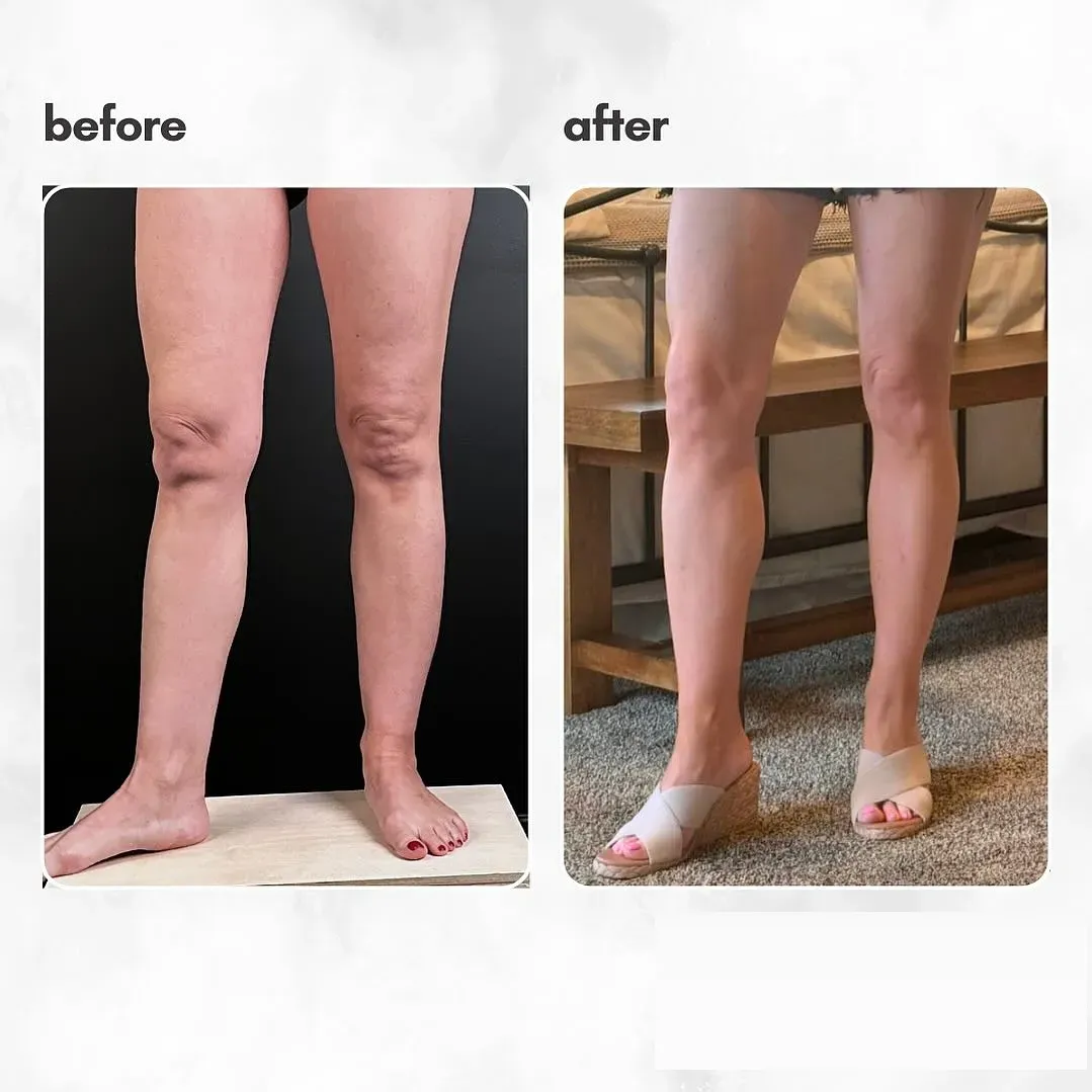Lipedema before-and-after comparison.