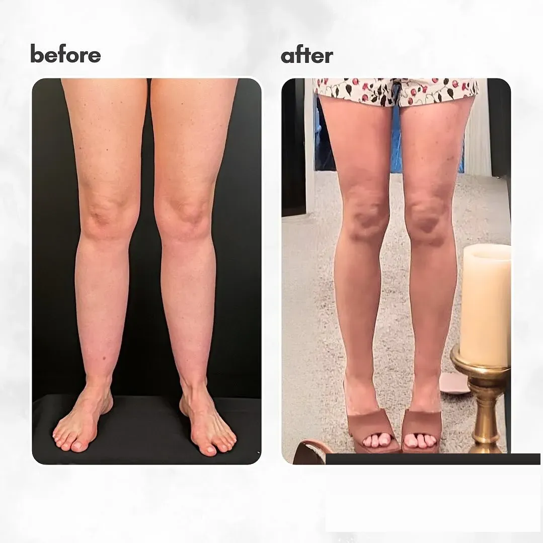 Lipedema before-and-after comparison.