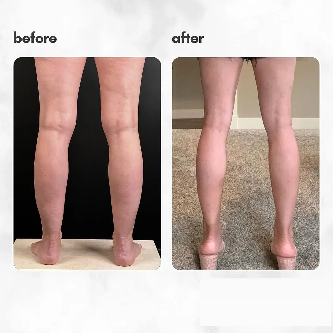 Lipedema before-and-after comparison.