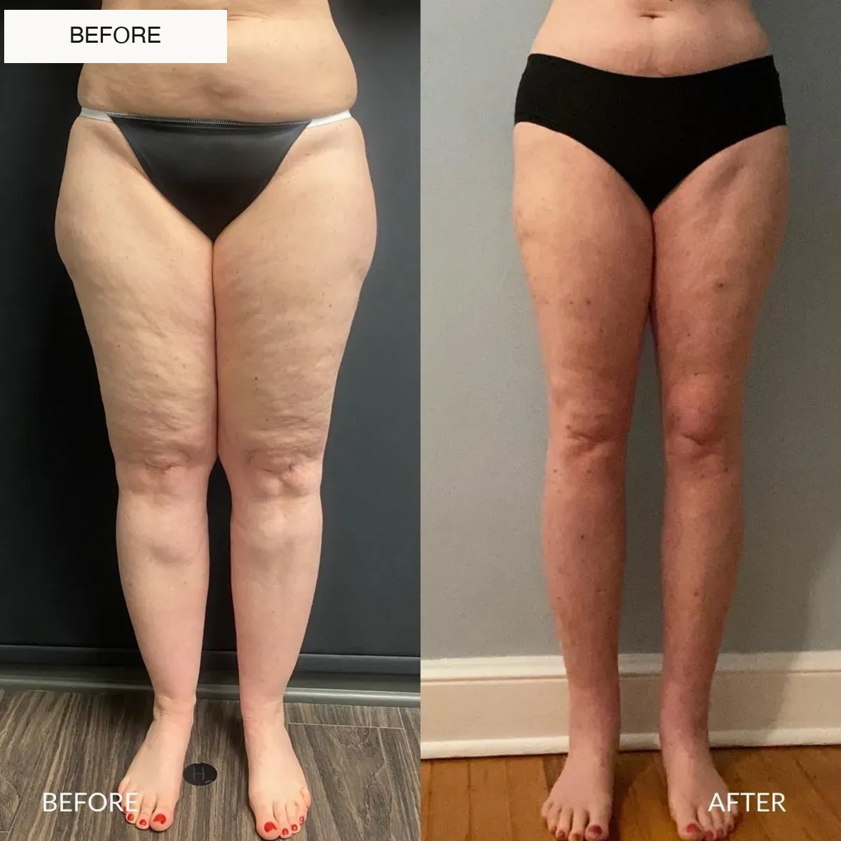 Lipedema before-and-after comparison.