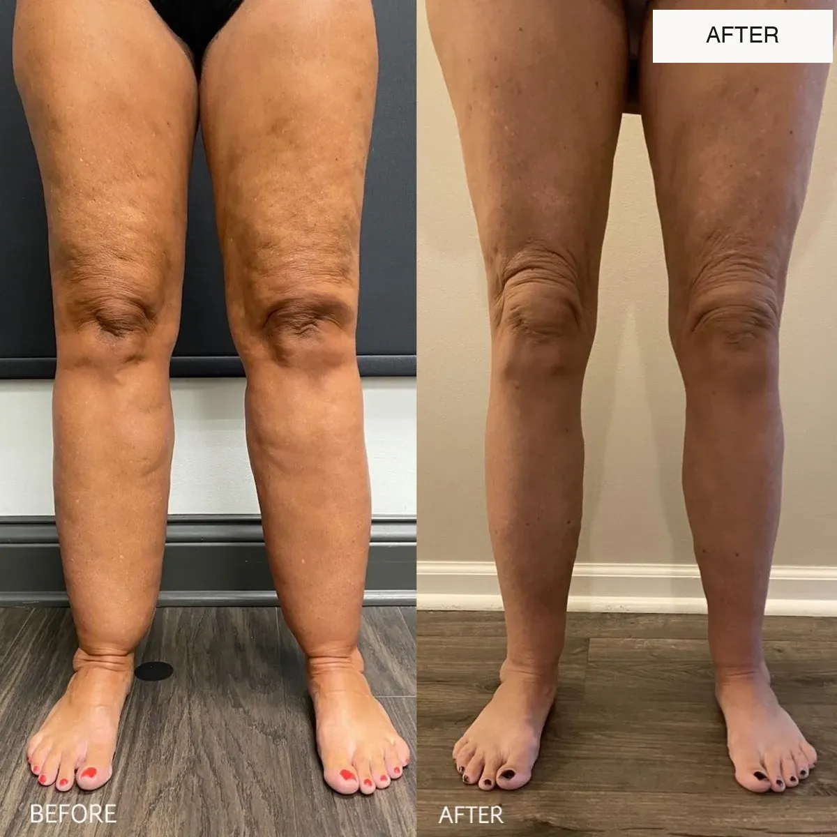 Lipedema before-and-after comparison.