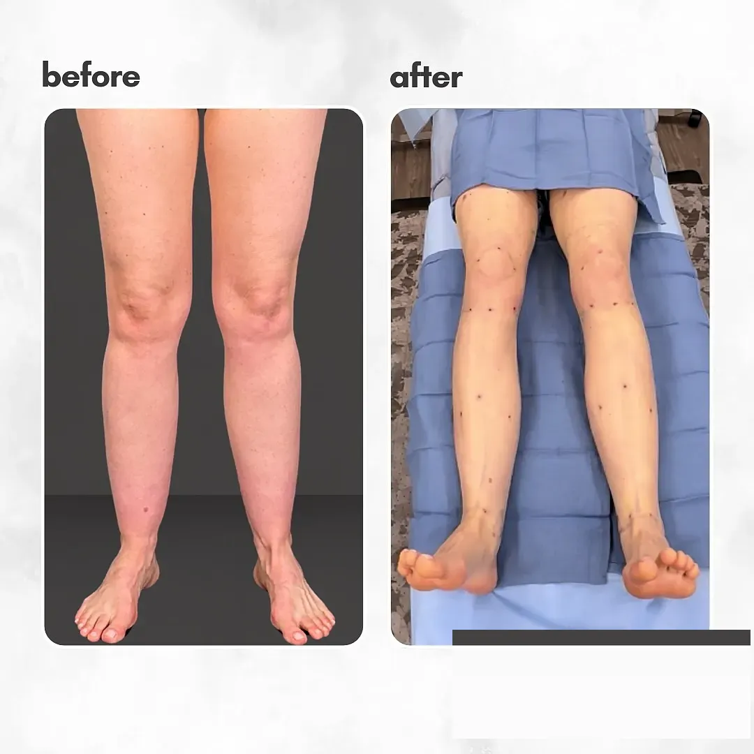 Lipedema before-and-after comparison.