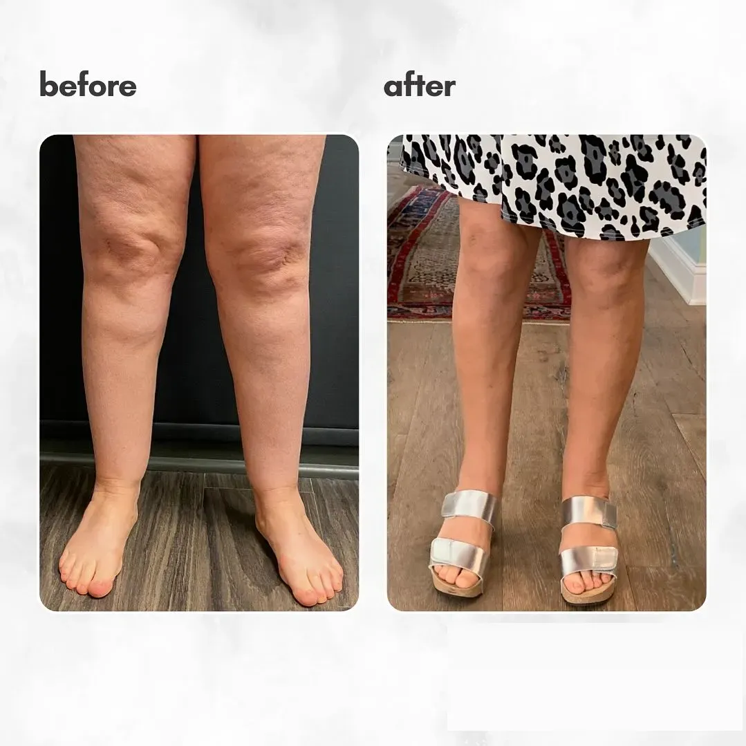 Lipedema before-and-after comparison.