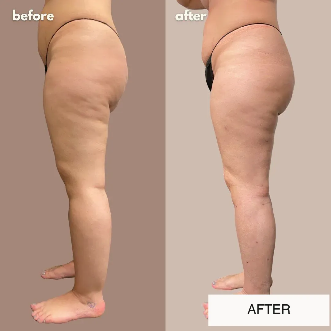 Lipedema before-and-after comparison.