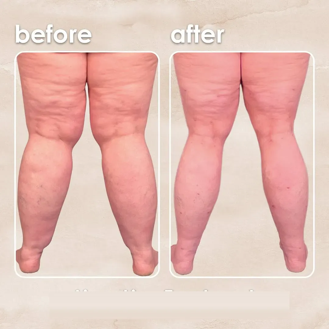 Lipedema before-and-after comparison.