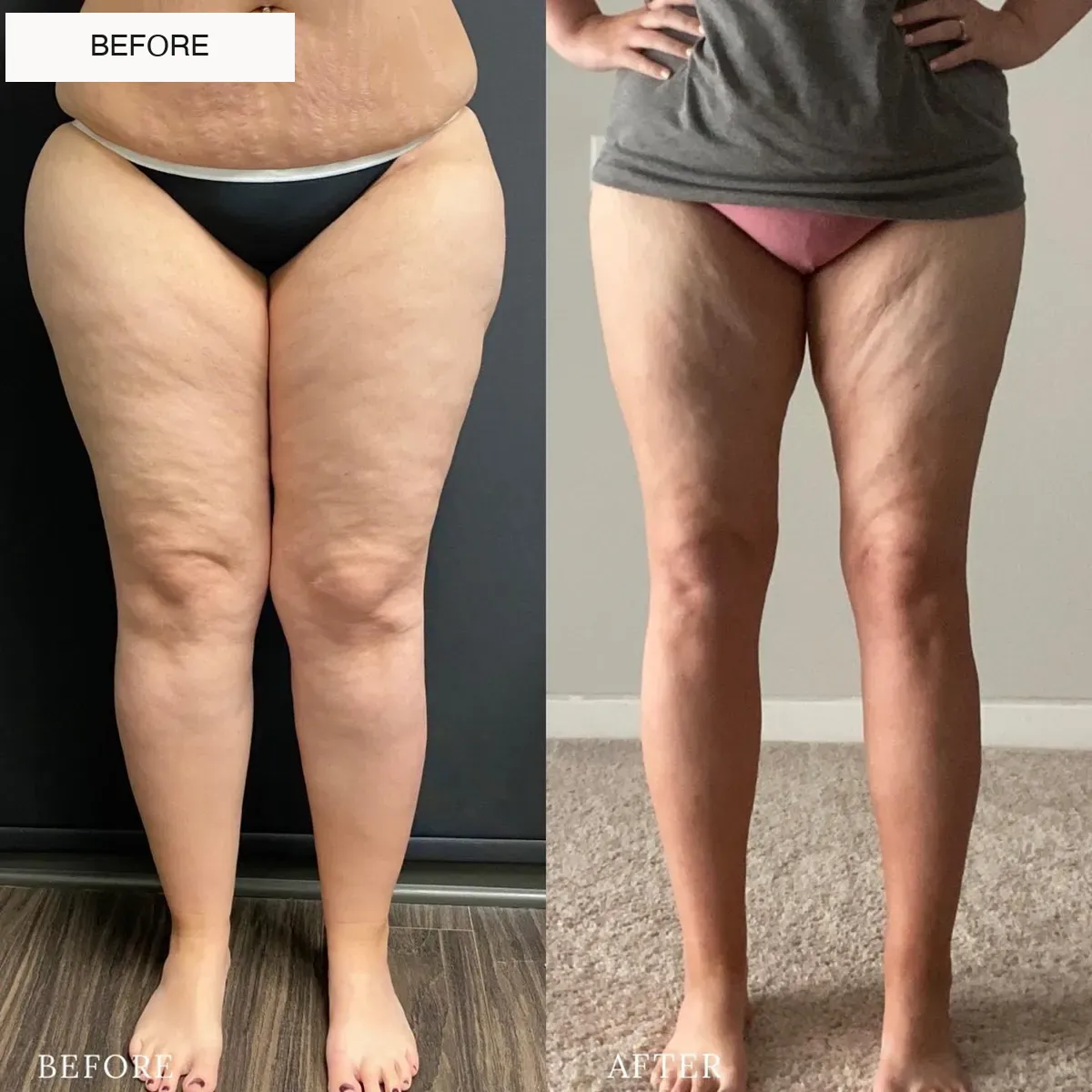 Lipedema before-and-after comparison.