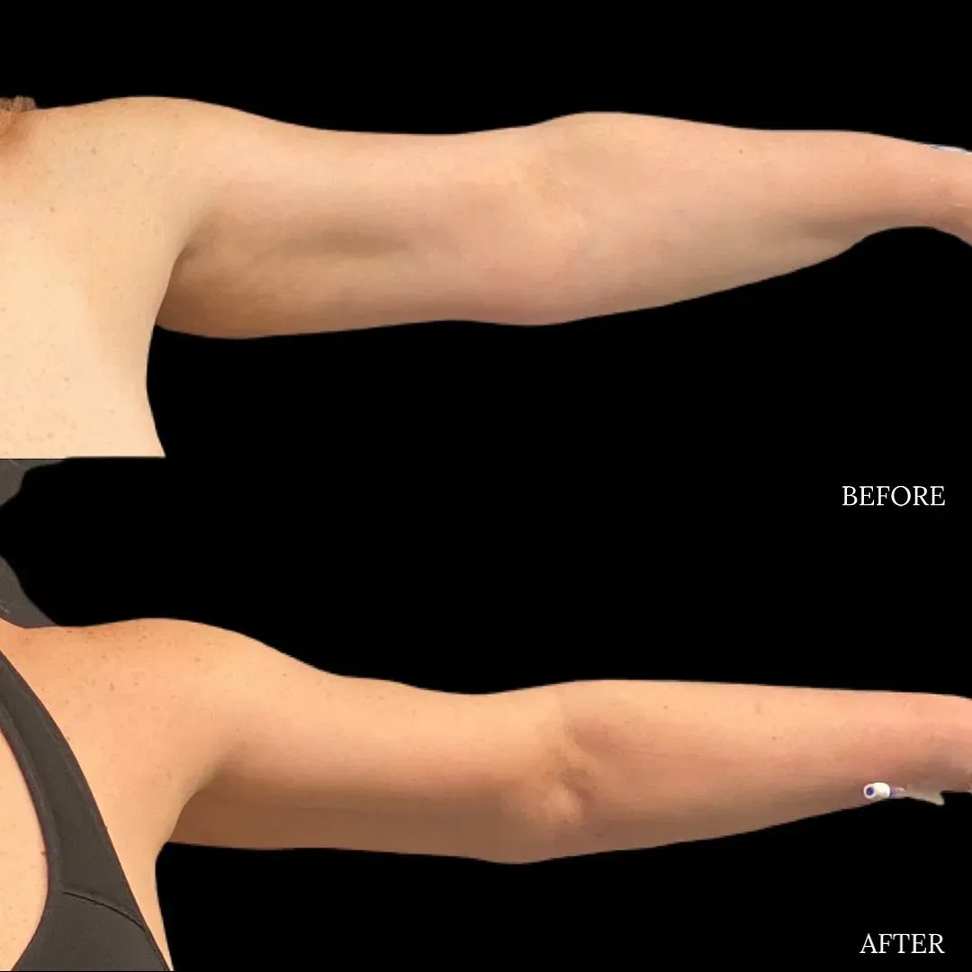 Lipedema before-and-after comparison.