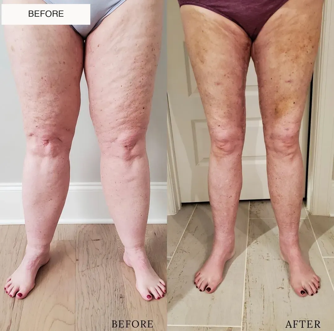 Lipedema before-and-after comparison.