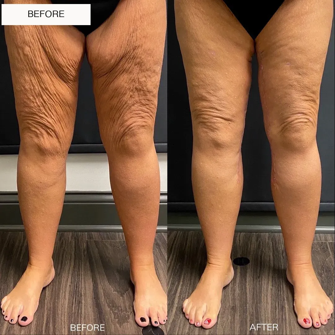 Lipedema before-and-after comparison.