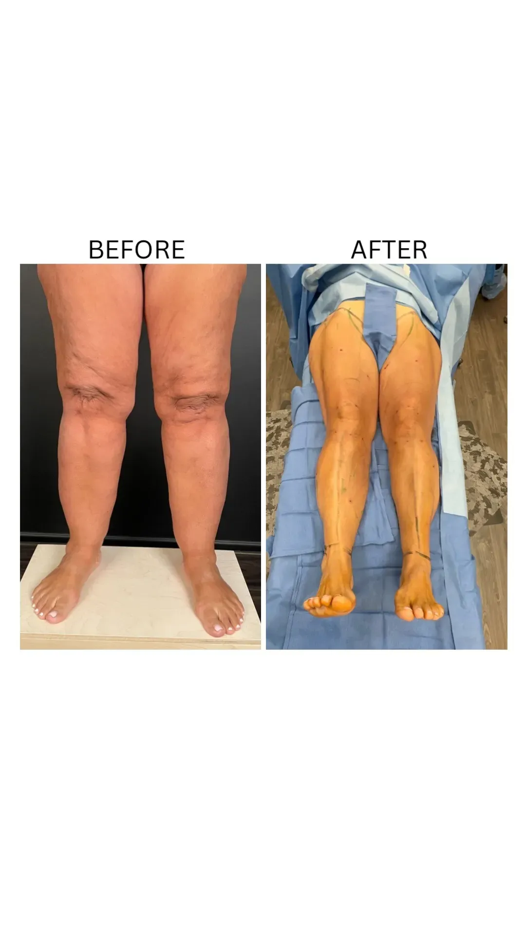 Lipedema before-and-after comparison.