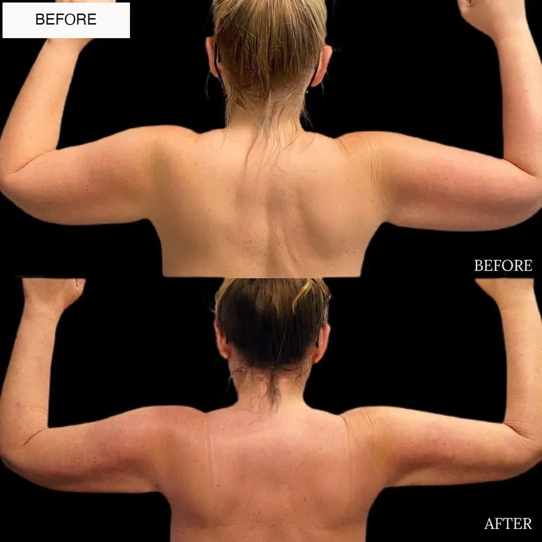 Lipedema before-and-after comparison.