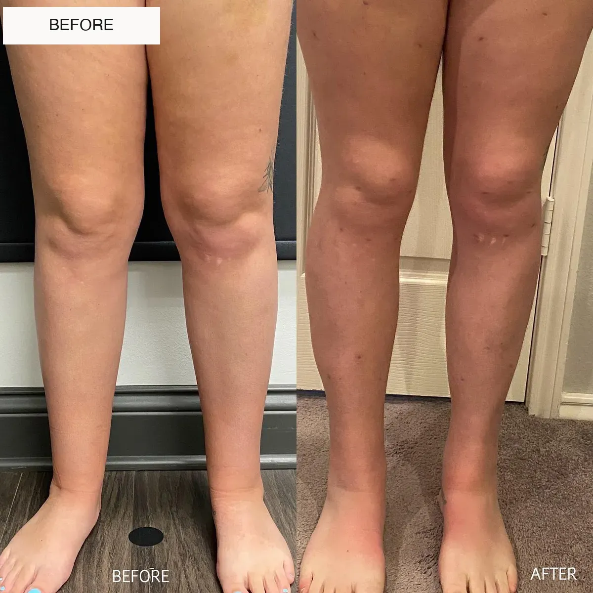 Lipedema before-and-after comparison.