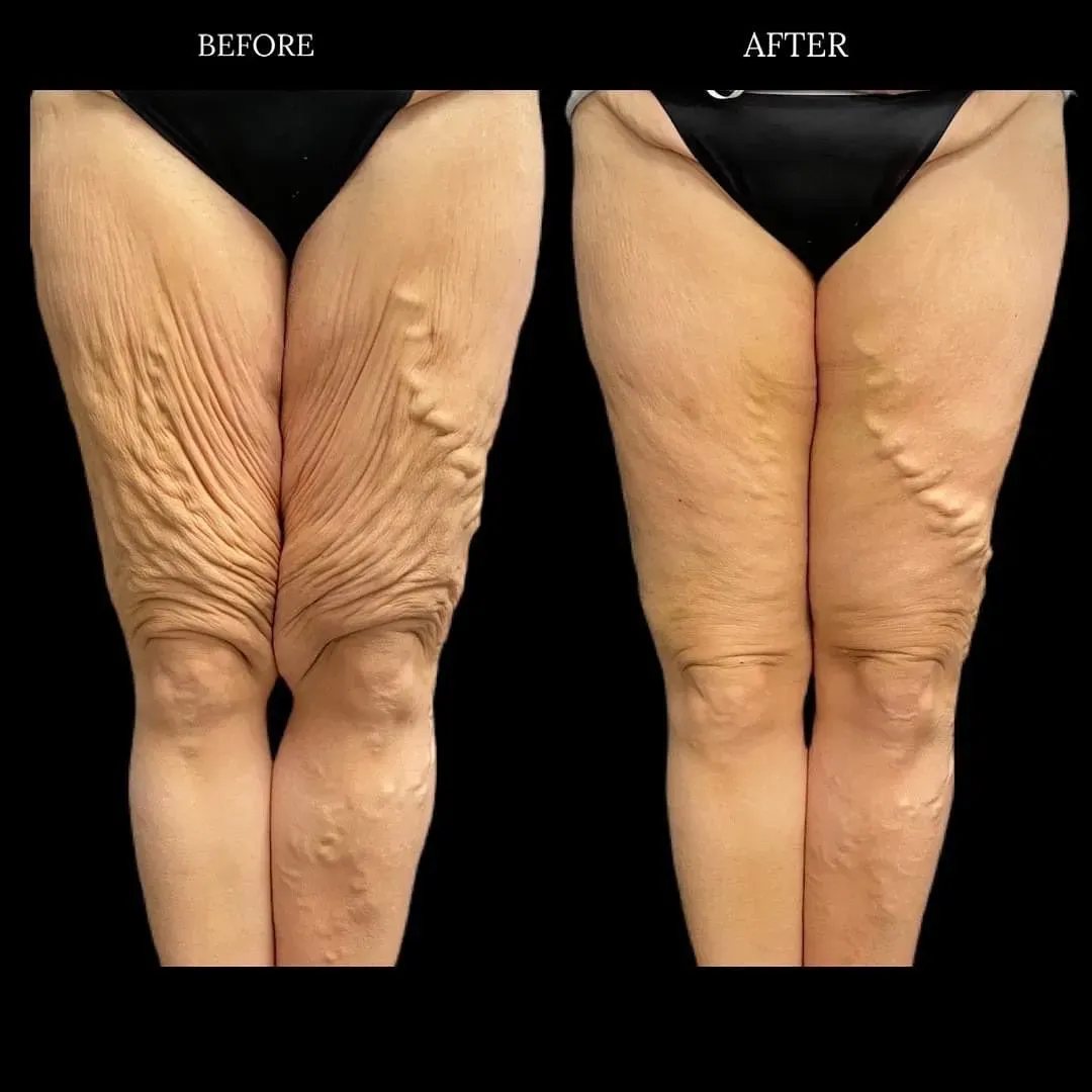 Lipedema before-and-after comparison.