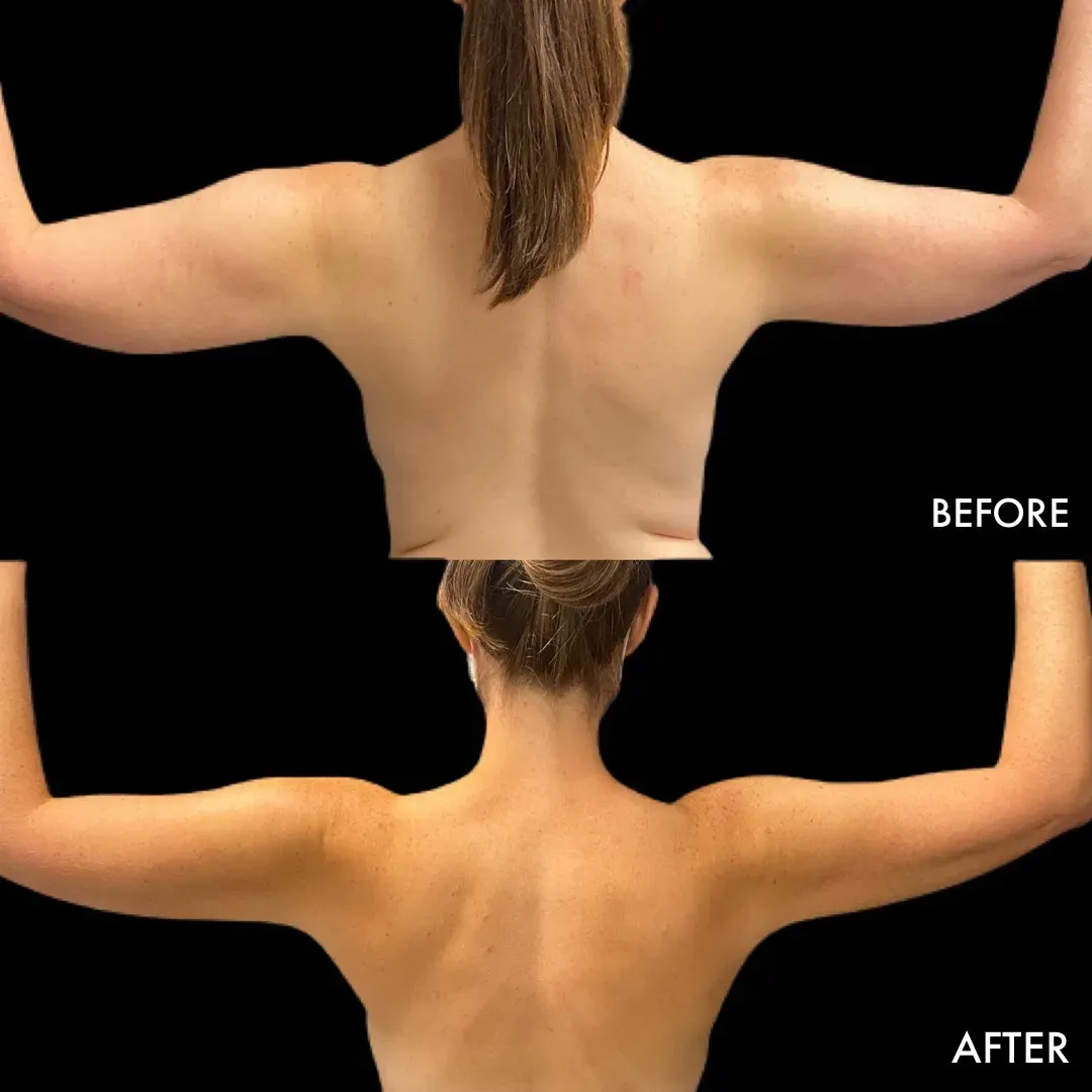 Lipedema before-and-after comparison.