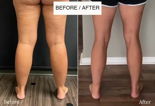 Lipedema before-and-after comparison.