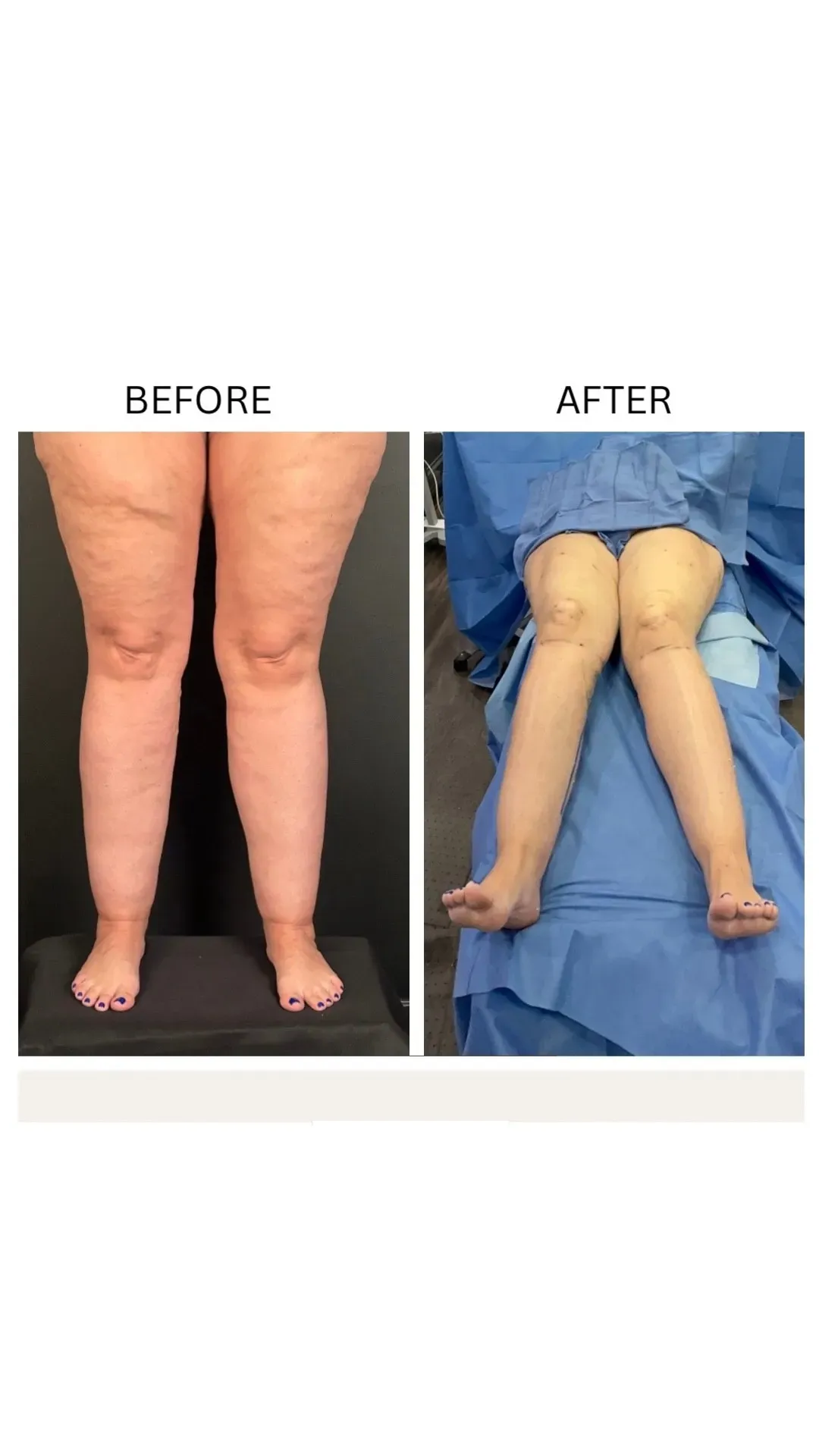 Lipedema before-and-after comparison.