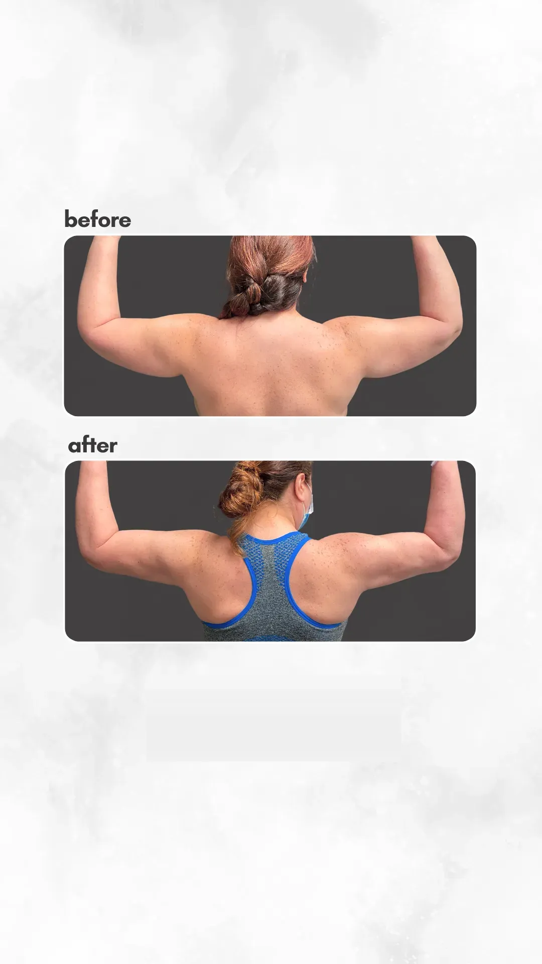 Lipedema before-and-after comparison.