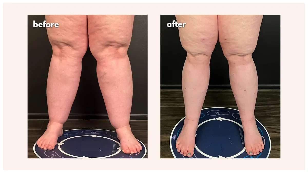 Lipedema before-and-after comparison.