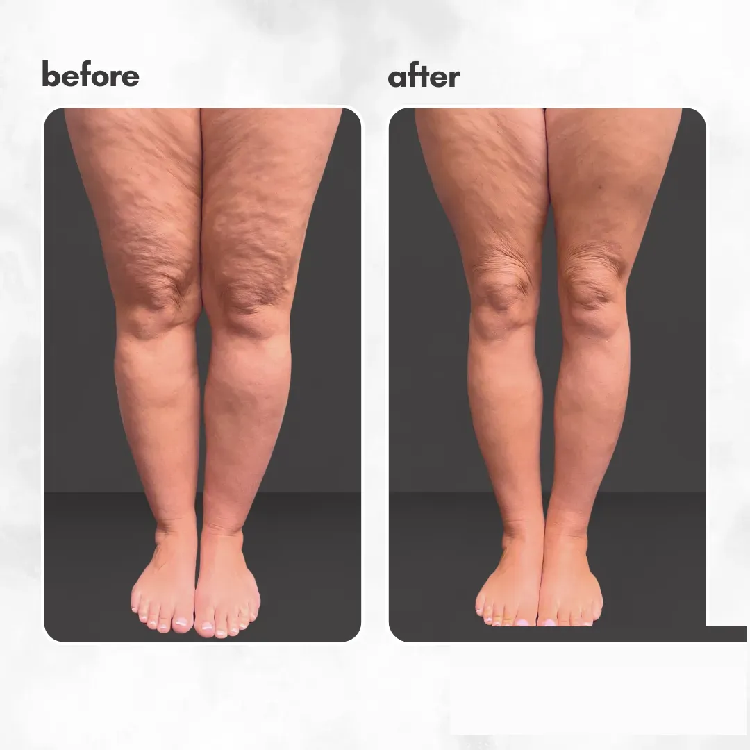 Lipedema before-and-after comparison.