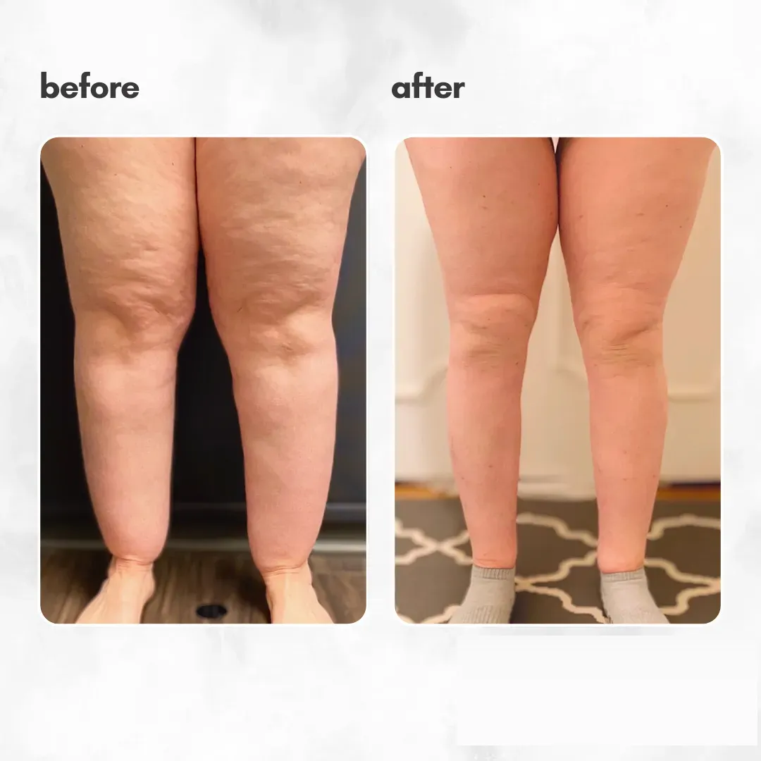 Lipedema before-and-after comparison.