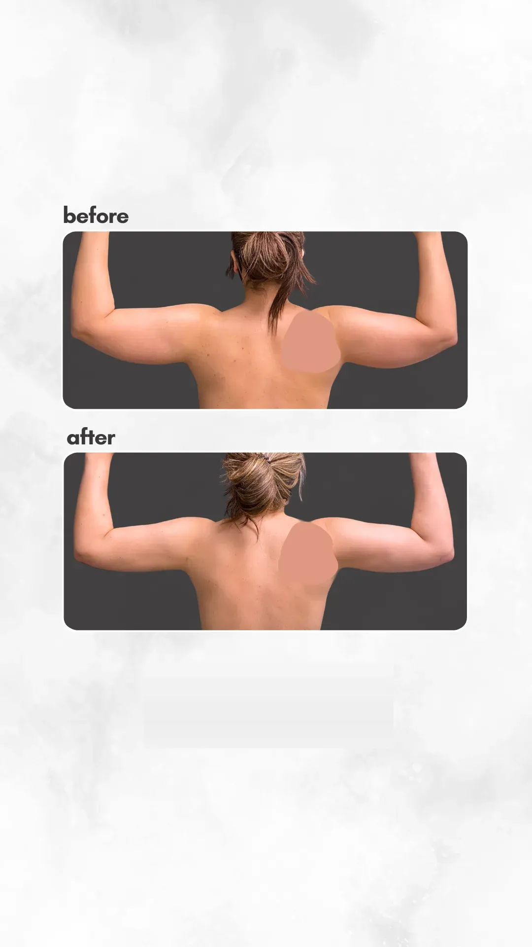 Lipedema before-and-after comparison.