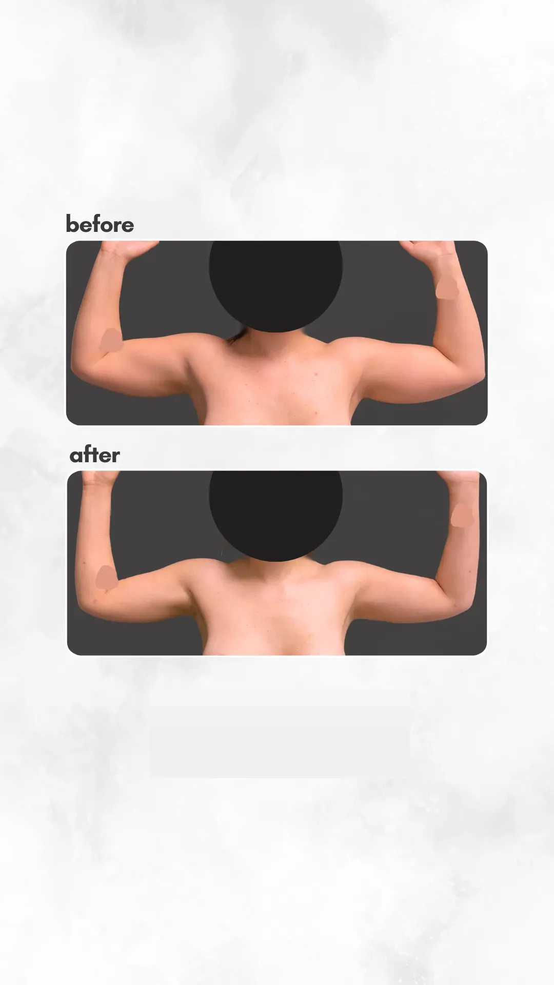 Lipedema before-and-after comparison.