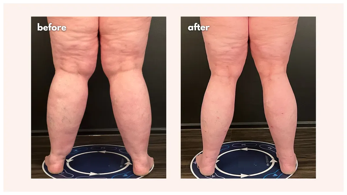 Lipedema before-and-after comparison.