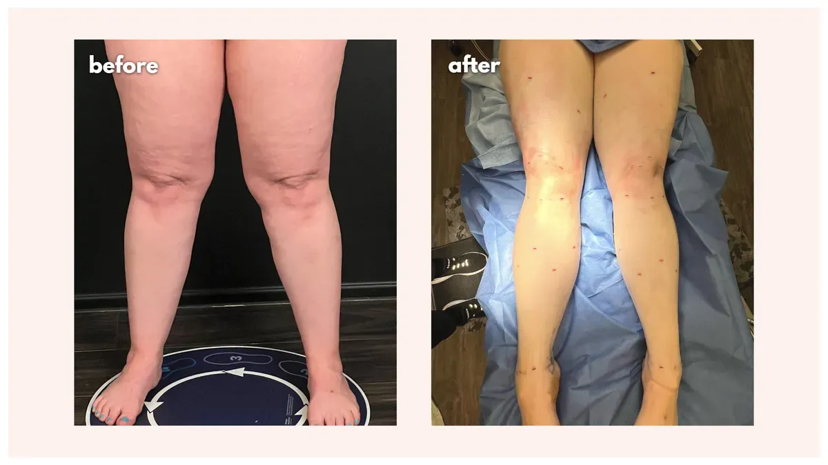 Lipedema before-and-after comparison.