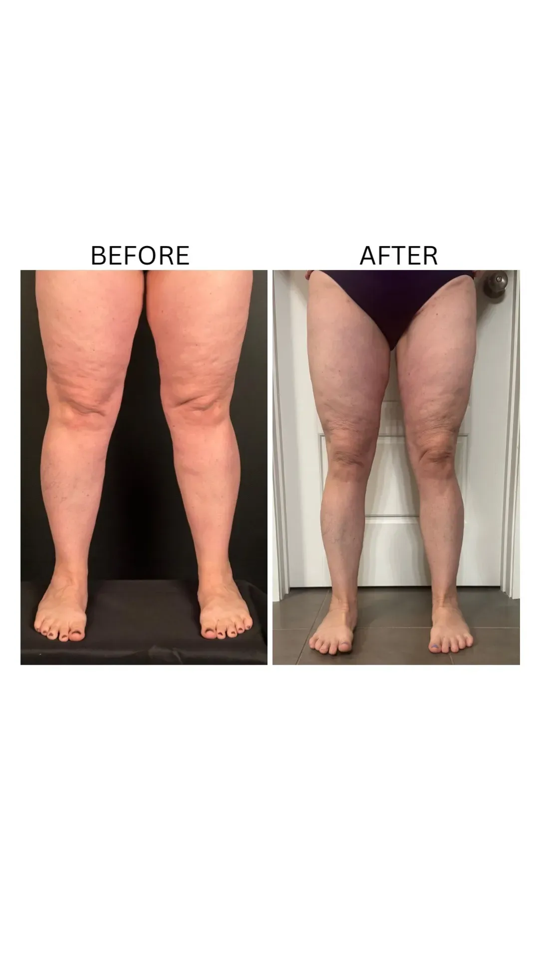 Lipedema before-and-after comparison.
