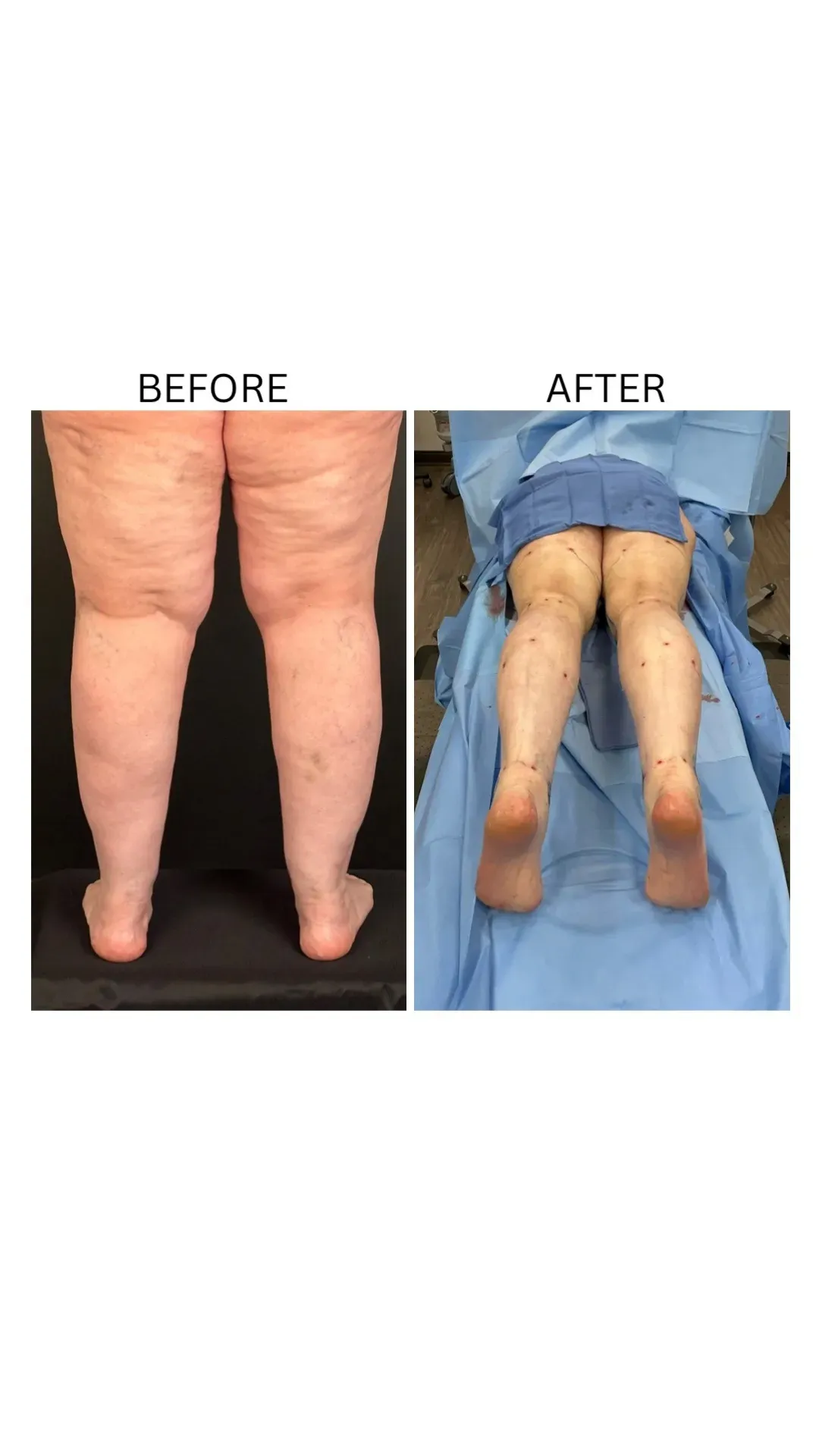Lipedema before-and-after comparison.