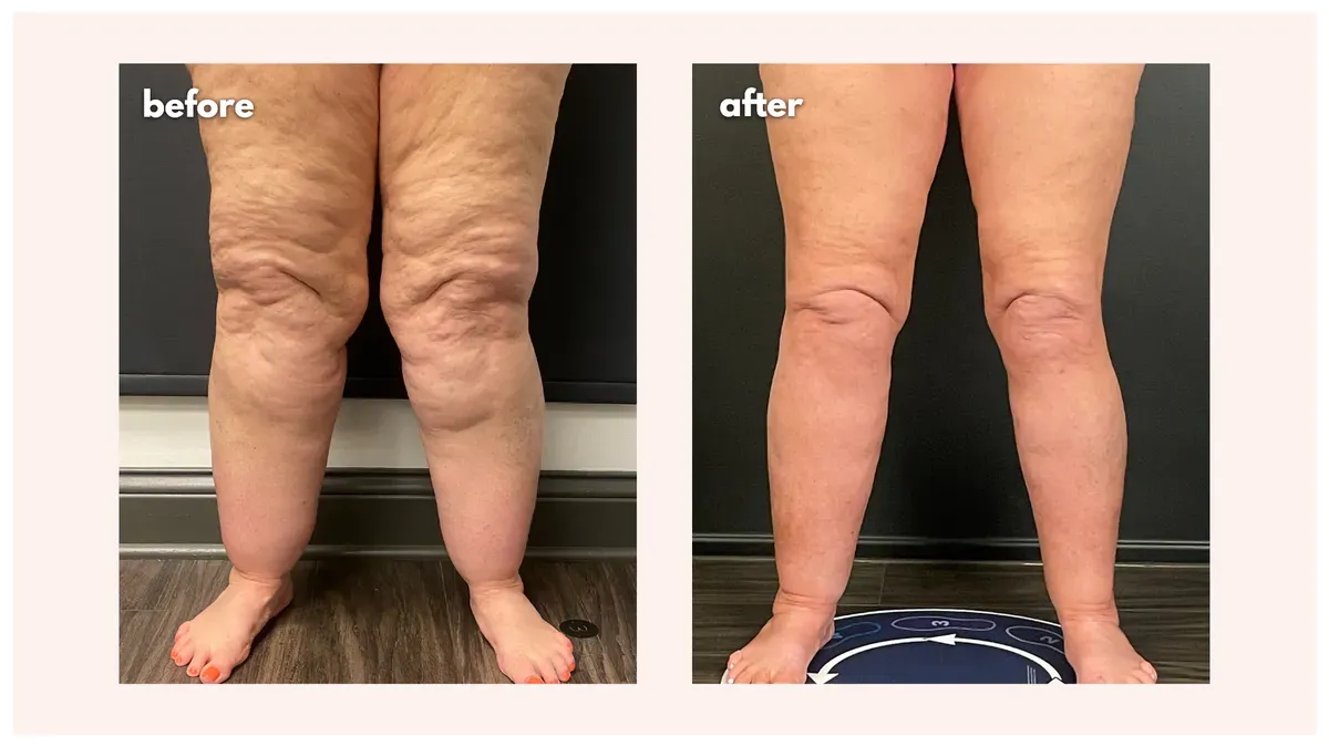 Lipedema before-and-after comparison.